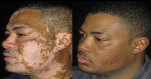 Las cremas y las máscaras de las pecas